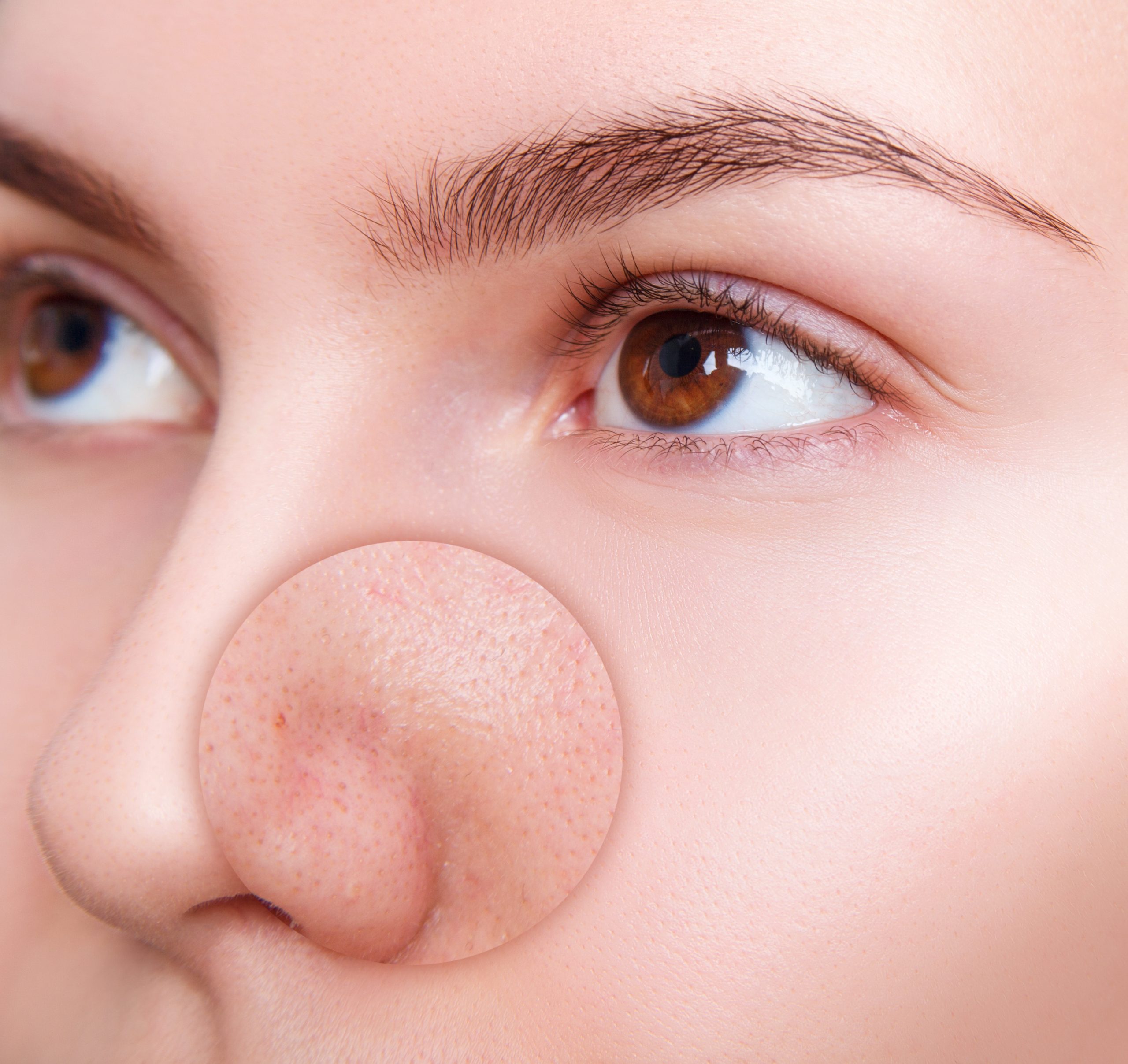 ハイドラで毛穴の黒ずみが増える！？毛穴治療の間違いとは！陶器肌の