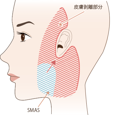 膚とSMAS筋膜を剥離・引き上げる