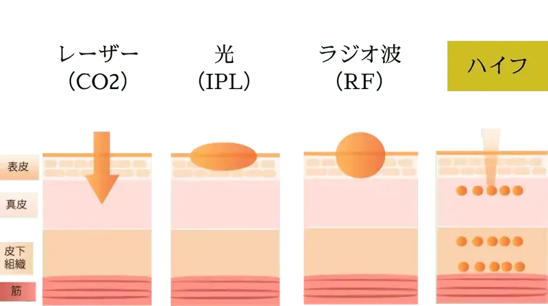 ハイフ（HIFU）と他治療との違い