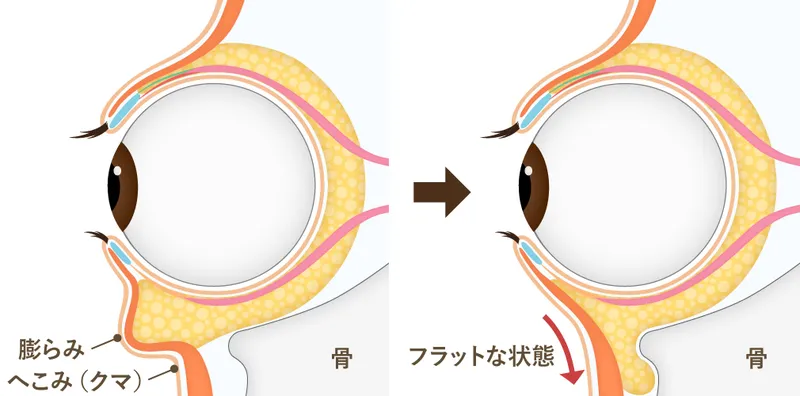 裏ハムラ法の仕組み