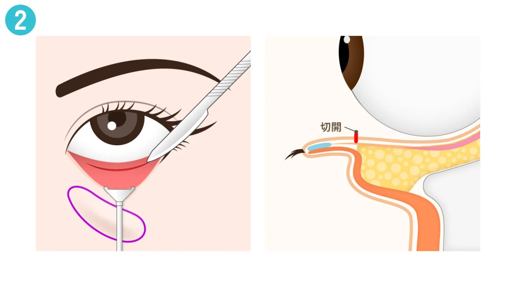 経結膜側から切開