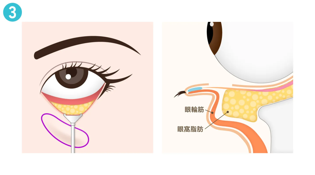 眼輪筋と眼窩脂肪の間を剥離
