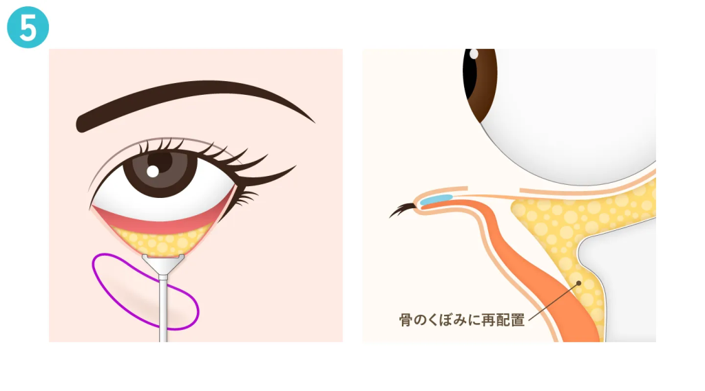 脂肪の再配置・固定