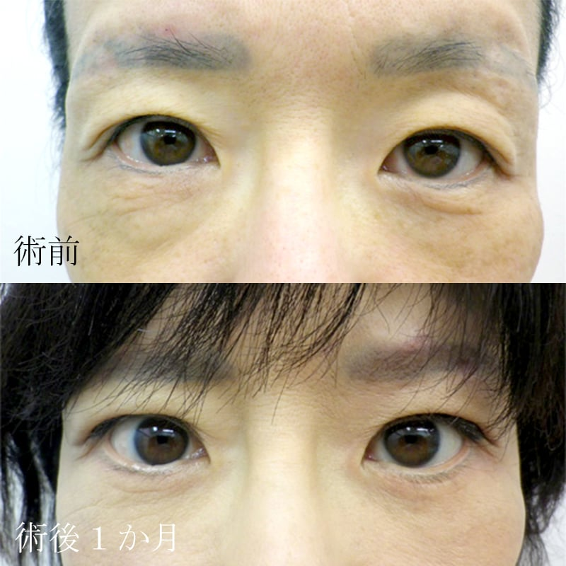眼瞼下垂手術の症例写真②
