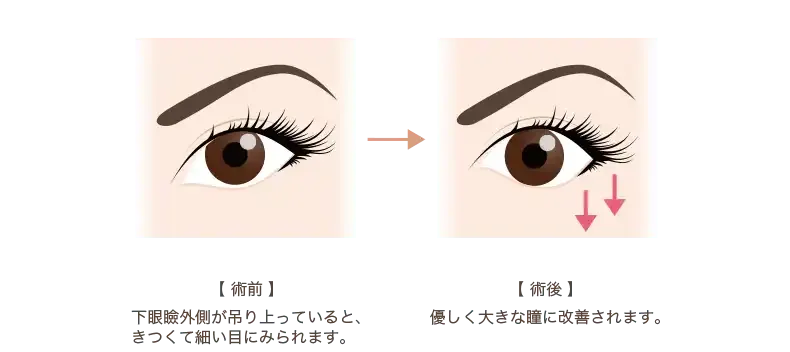 タレ目形成（グラマラスライン）とは