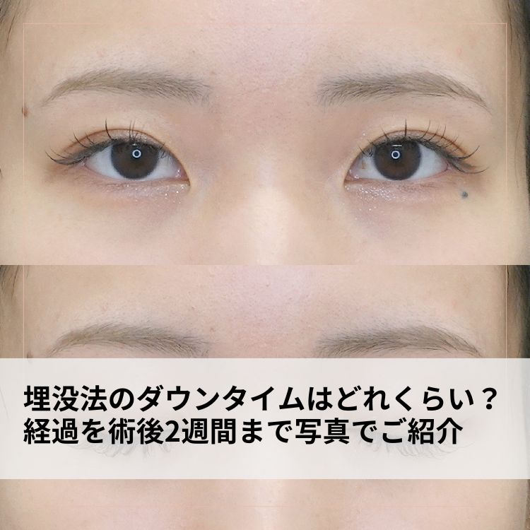埋没法のダウンタイムはどれくらい？経過を術後2週間まで写真でご紹介