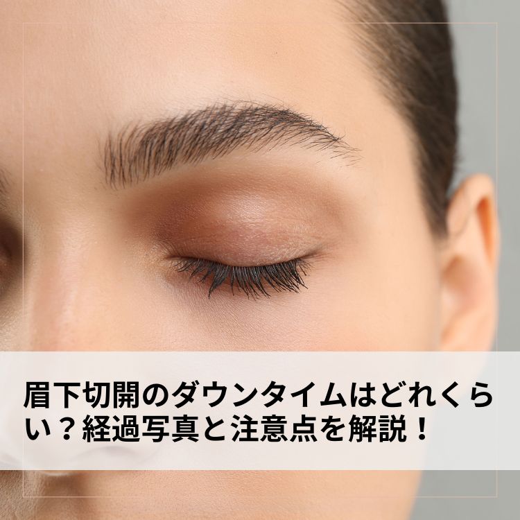 眉下切開のダウンタイムはどれくらい？経過写真と注意点を解説！