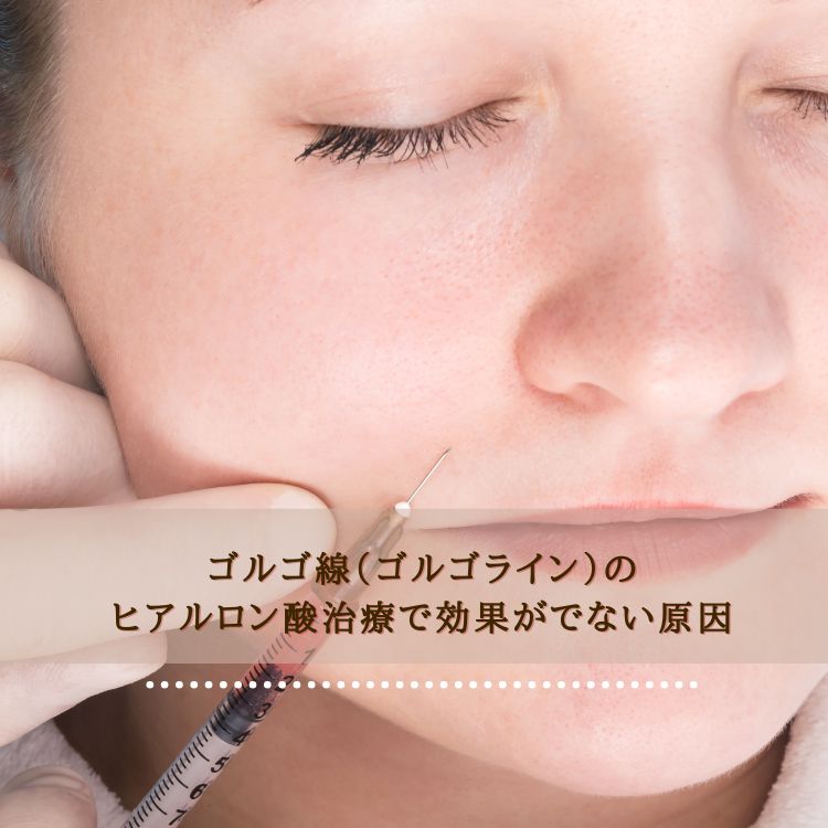 ゴルゴ線（ゴルゴライン）のヒアルロン酸治療で効果がでない原因