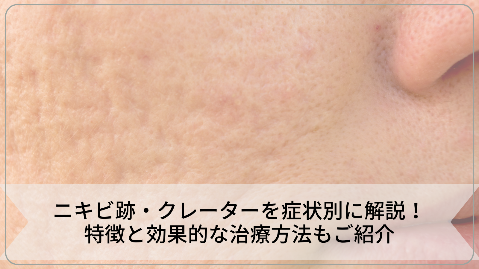 20 OFF 7 11 1 59まで 公式 ニキビ 跡 クレーター クリーム マスク 肌荒れ 対策 植物幹細胞エキス配合 リプロスキン ジェルクリーム 50g メンズ レディース 大人 色素沈着 消し 凸凹 脂性肌 クレーター肌 乾燥肌 セラミド 保湿 母の日 美と