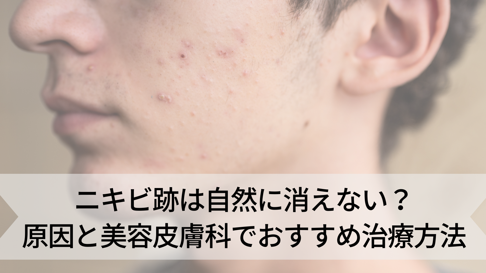 ニキビ 跡 消え ない