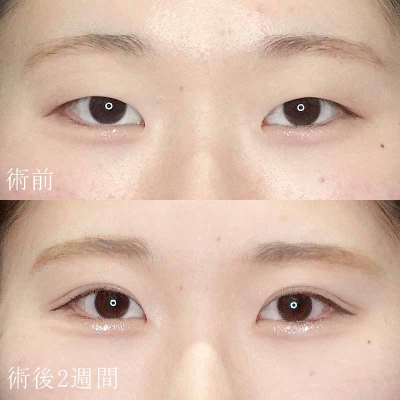 小糸医師の二重埋没法の症例写真①