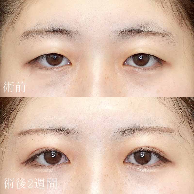 二重埋没法症例写真