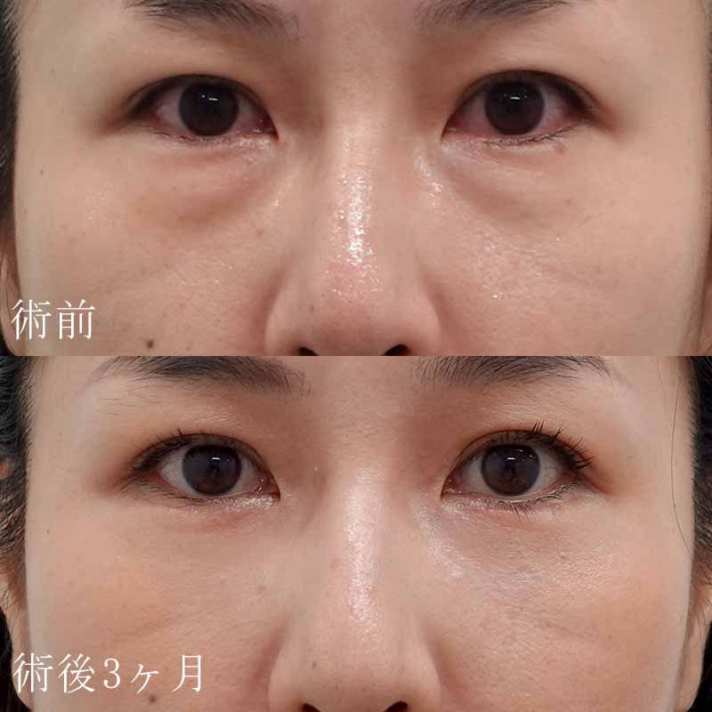 塚原医師のハムラ法症例写真②