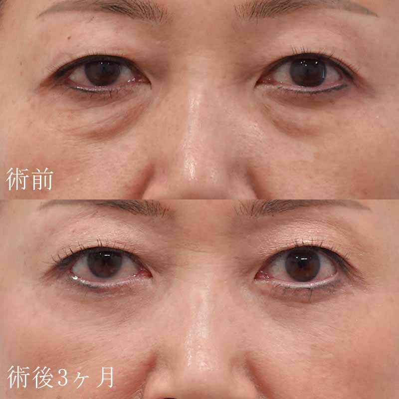 塚原医師のハムラ法症例写真①