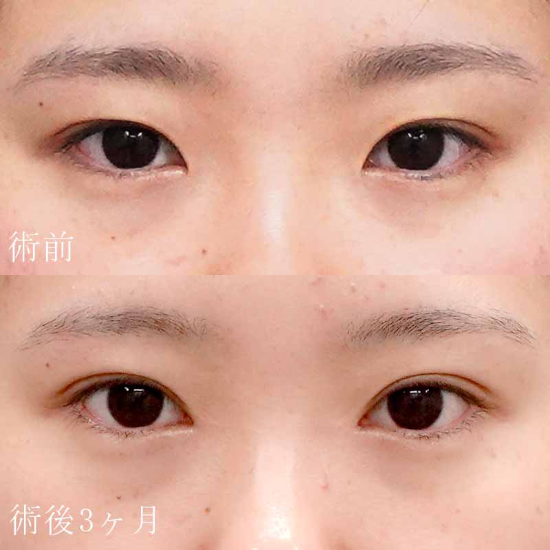 二重埋没法＋目頭切開法の症例写真