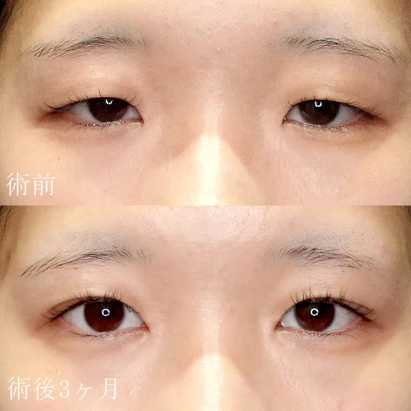二重埋没法＋目頭切開法症例写真