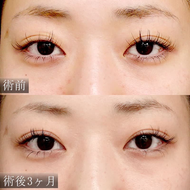 杉島先生の二重切開法の症例写真