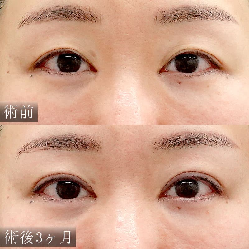 小野先生の二重切開法の症例写真