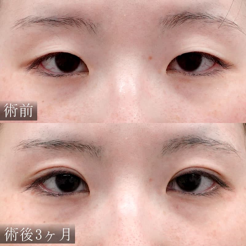 小野医師の二重切開法の症例写真②