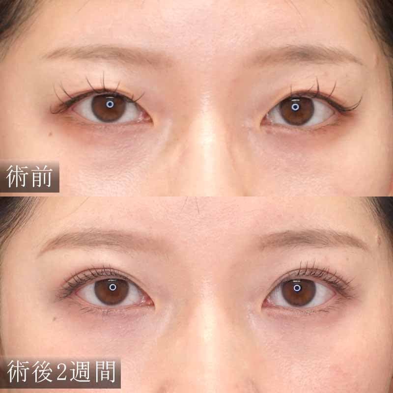 東京渋谷院村上先生の二重埋没法症例