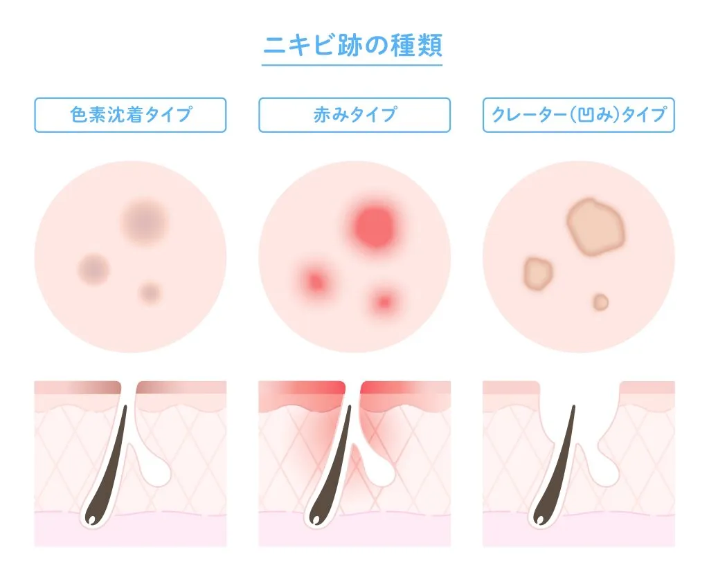 主なニキビ跡の種類