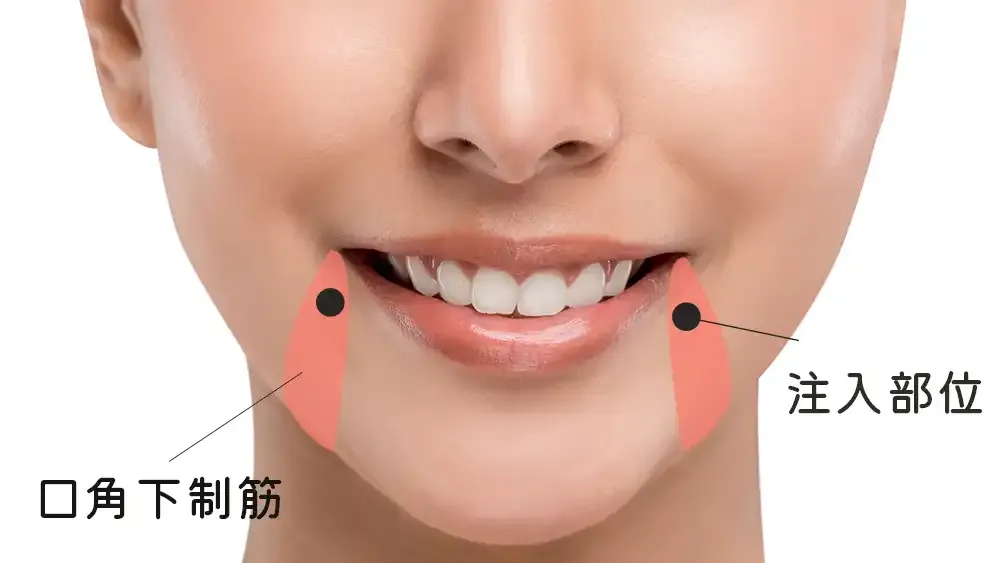 口角下制肌と口角の注入部位