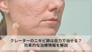 クレーターのニキビ跡は自力で治せる？効果的な治療情報を解説