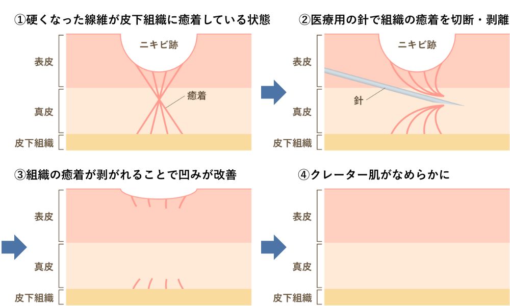 サブシジョンの施術方法