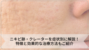 ニキビ跡・クレーターを症状別に解説！特徴と効果的な治療方法もご紹介