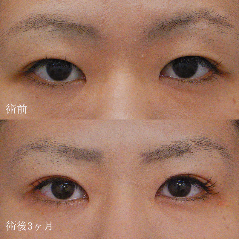 福岡院金子医師の二重切開法の症例写真②