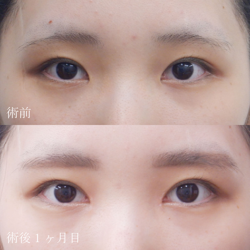 西川医師目頭切開症例写真