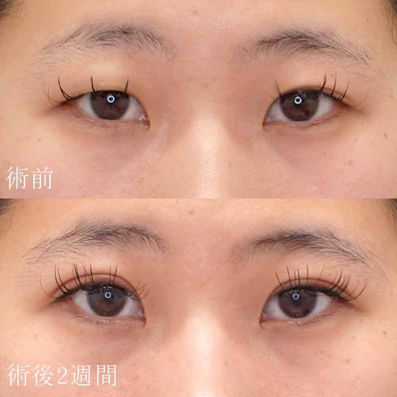 酒井医師の二重埋没法症例写真