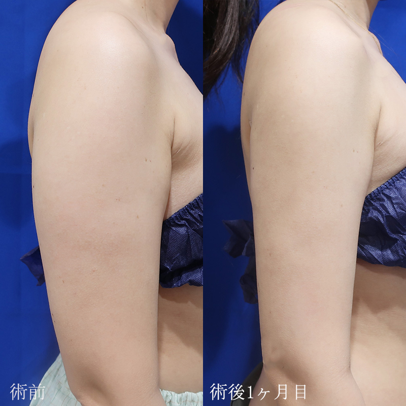 二の腕の脂肪吸引の症例写真③