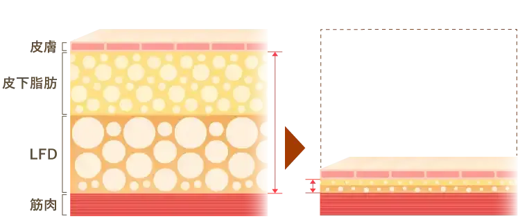 脂肪吸引の仕組み