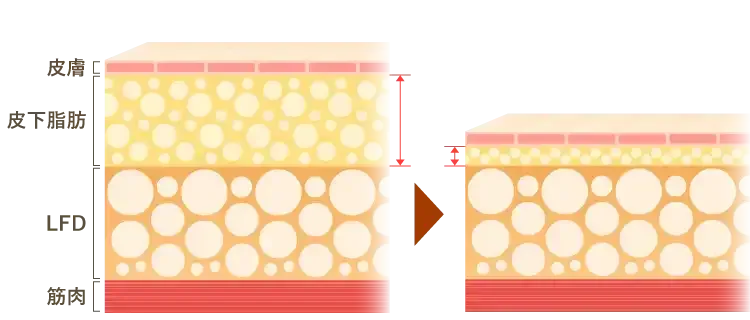 脂肪吸引の原理