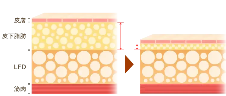 脂肪吸引の原理
