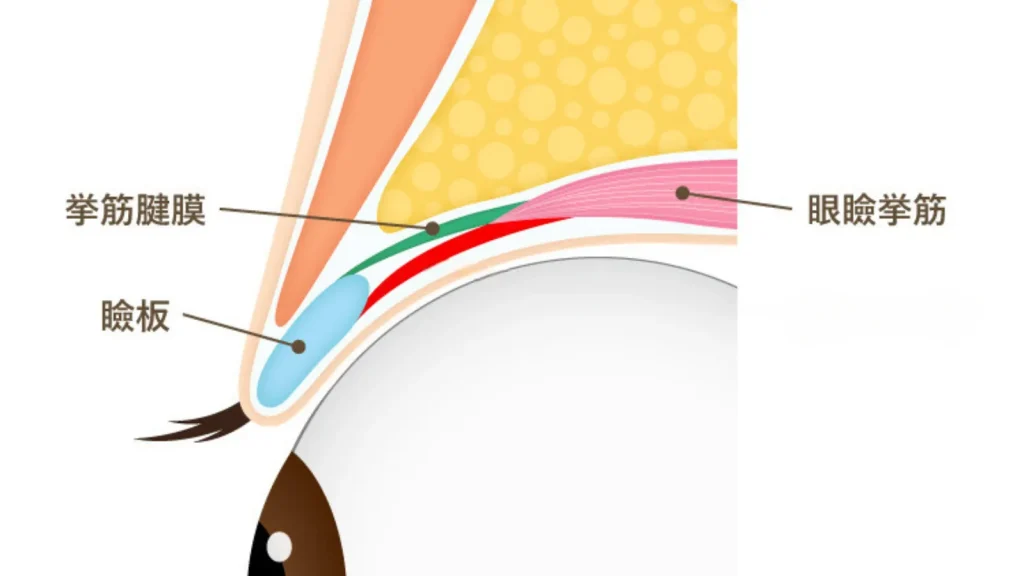 瞼板法と挙筋法の違いは糸をかける位置