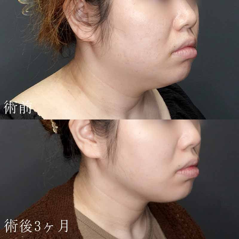 顔の脂肪吸引＋エラのボトックス注射の症例写真