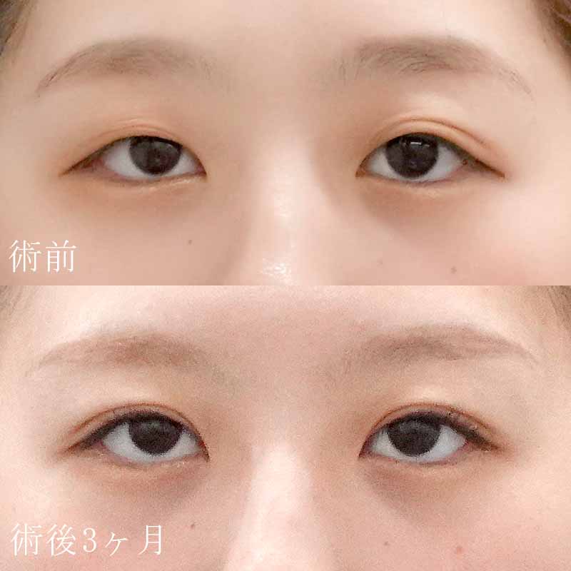 二重切開法症例写真