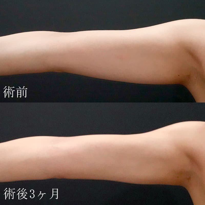20250823_F125985_nagahama_arm-liposuctionメイン横
