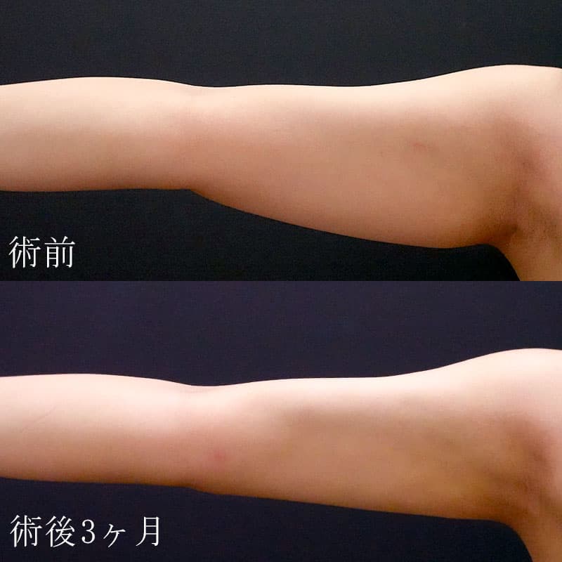 20250823_F127425_nagahama_arm-liposuctionメイン横