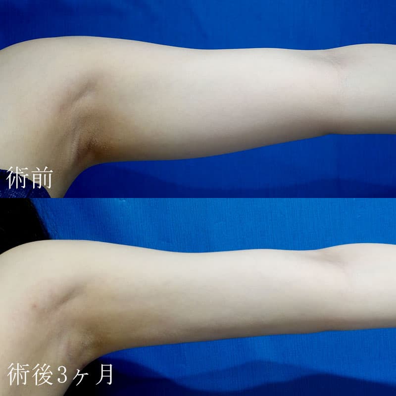 二の腕の脂肪吸引の症例写真