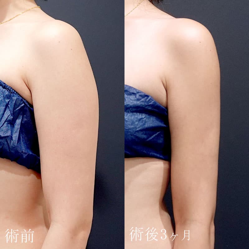 二の腕の脂肪吸引の症例写真