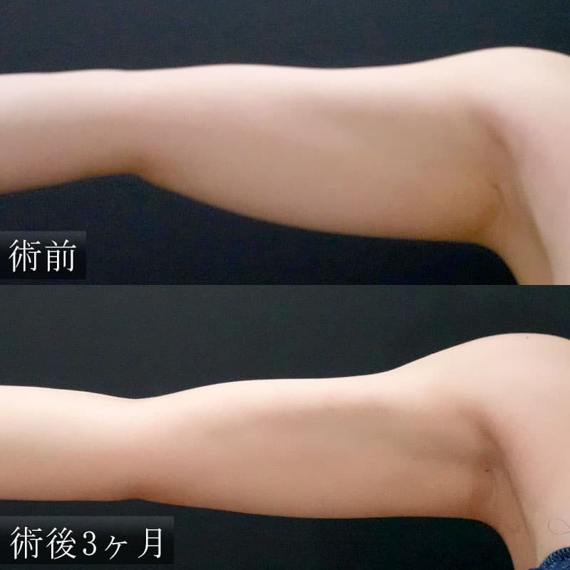 二の腕の脂肪吸引の症例写真