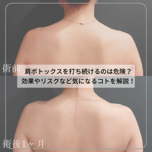 肩ボトックスを打ち続けるのは危険?効果やリスクなど気になるコトを解説!