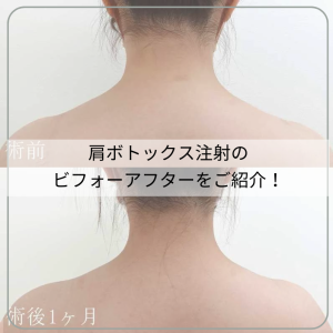 肩ボトックス注射のビフォーアフターをご紹介!施術方法や効果も解説