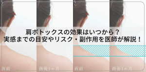 肩ボトックスの効果はいつから?実感までの目安やリスク・副作用を医師が解説!