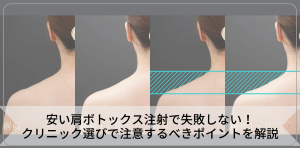 安い肩ボトックス注射で失敗しない！クリニック選びで注意するべきポイントを解説