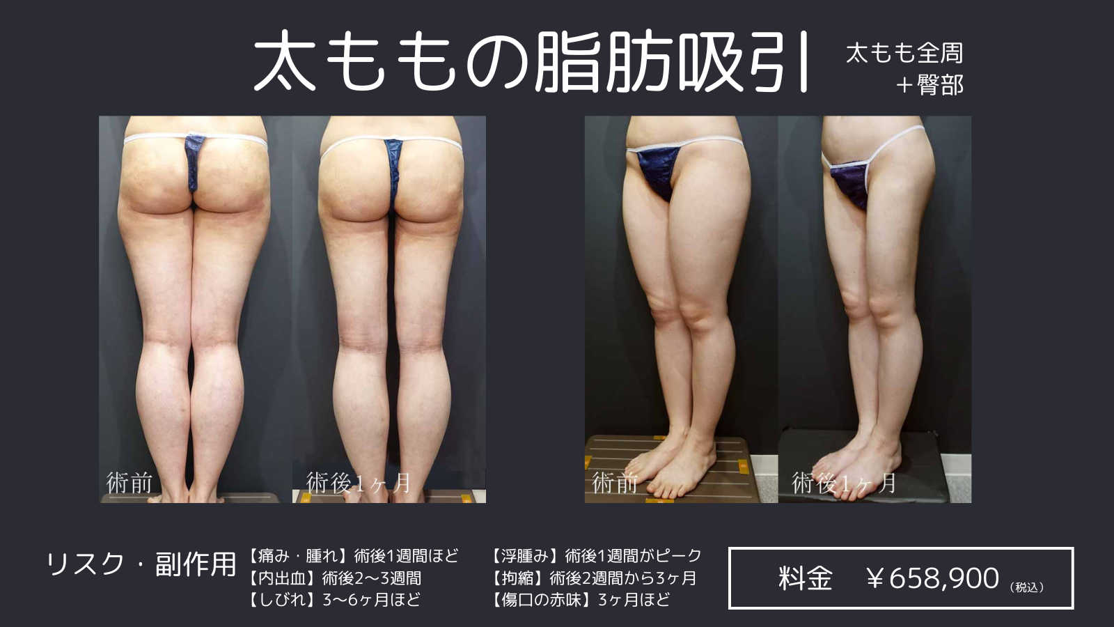 脂肪 吸引 デメリット