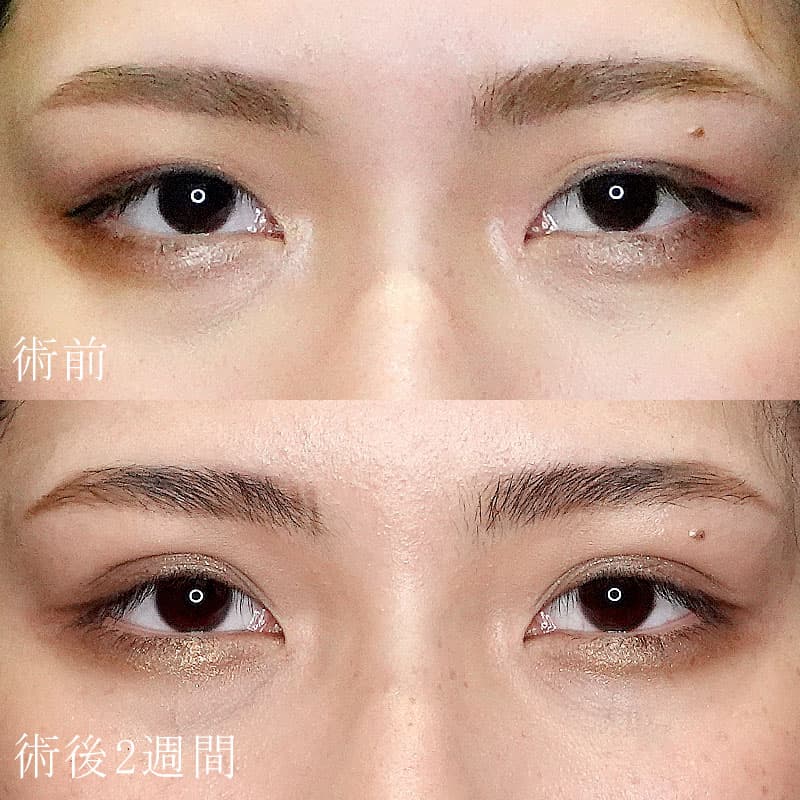 二重埋没法症例写真
